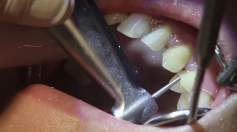 Grinding teeth for dental veneers Stock Footage 61156189