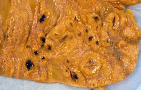 Gross pathology of the caecum and appendix Stock Illustration