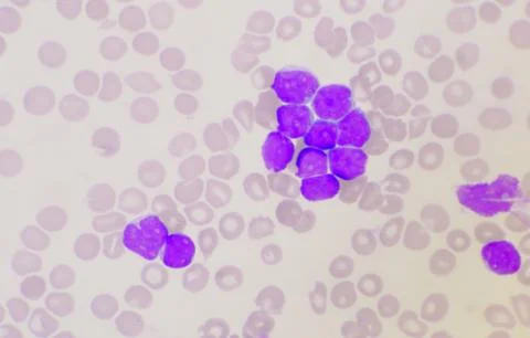 Group of blast cells in leukemia background. Stock Photos