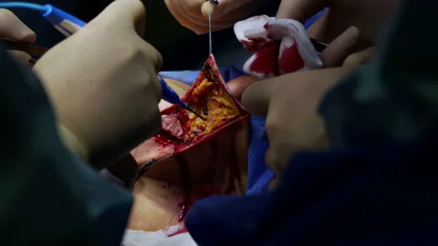 Group of doctors in the operating room performs an operation to remove cancer 스톡 동영상 155902839