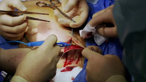 Group of doctors in the operating room performs an operation to remove Stock Footage 156195174