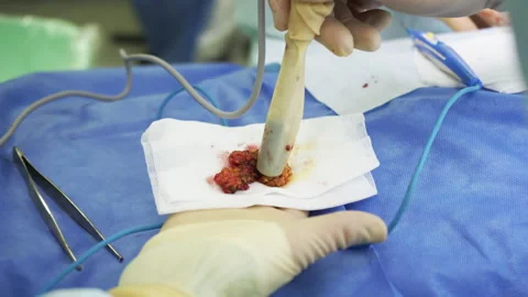 Group of doctors uses a radioactive method to check a removed cancer Stock Footage 155902897