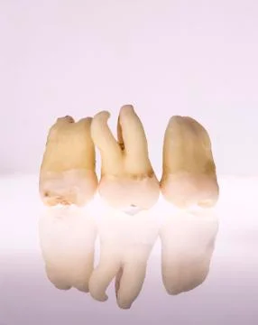 Group of extracted teeth Stock Photos