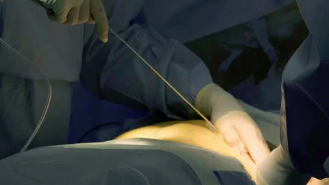 A group of professional mixed race surgeons in uniform performing Stock Footage 270466930