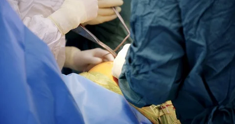 A group of surgeons performing a liposuction in operating theatre. Medicine Stock Footage 121102284