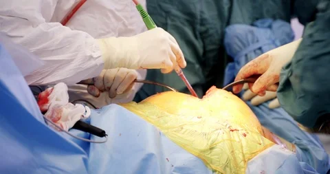 A group of surgeons at work. Closeup of operation on a hip. Medicine, surgery Stock Footage 121102651