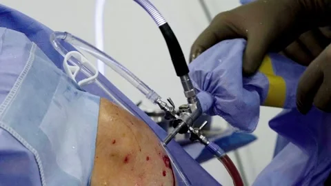 A group of surgeons works in the operating room. Stockbeeldmateriaal 269443245