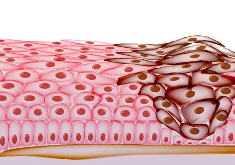 Growing Tumor, Tissue Section - Vector Illustration Stock Illustration