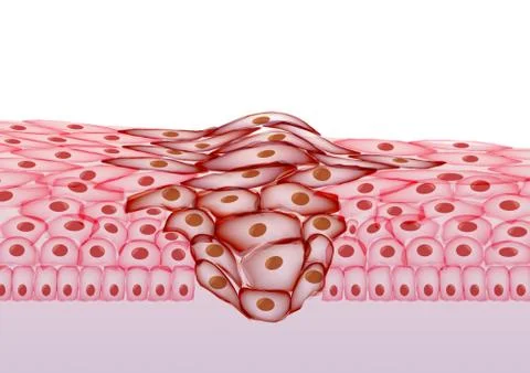 Growing Tumor, Tissue Section - Vector Illustration Stock Illustration