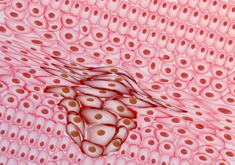 Growing Tumor, Tissue Section - Vector Illustration Stock Illustration