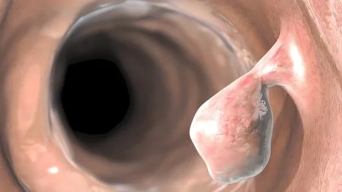 The growth that develops inside the colon is the name given to the colons. Stock Illustration