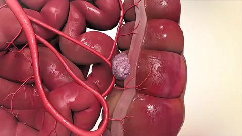 The growth that develops inside the colon is the name given to the colons. Stock Illustration