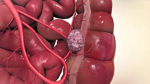 The growth that develops inside the colon is the name given to the colons. Stock Illustration