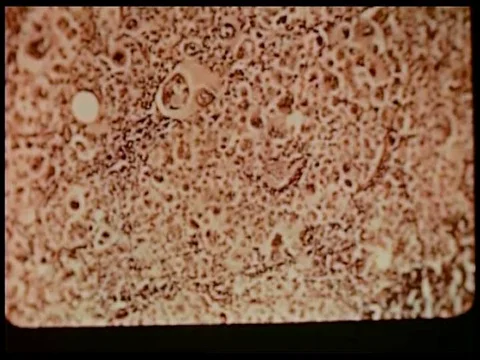 Gruesome cases of advanced metastasis around regional lymph nodes in instances Stock Footage 74965073