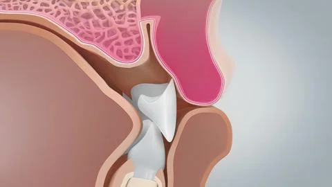 As the gum and connective tissues pull away from the tooth, a pocket forms be Illustrazione stock
