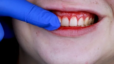 Gum bleeding and inflammation close up. A man examined by a dentist. The diagnos Video stock 124639405