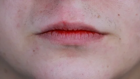 Gum bleeding and inflammation close up. A man examined by a dentist. The diagnos Stock-Footage 124639447