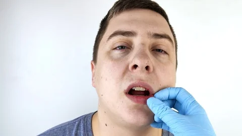 Gum bleeding and inflammation close up. A man examined by a dentist. The diagnos Stock Footage 126025133