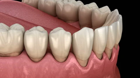 Gum recession process. Medically accurate 3D animation 库存影片 109046124