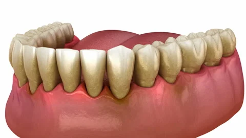 Gum recession process. Medically accurate 3D animation 库存影片 204141465