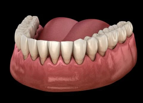 Gum recession process. Medically accurate 3D illustration Stock Illustration