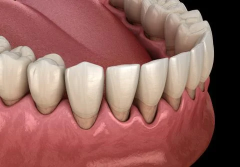 Gum recession process. Medically accurate 3D illustration Stock Illustration