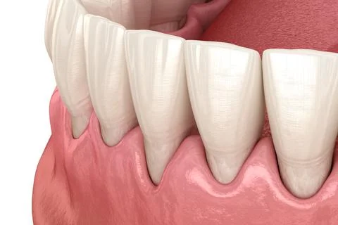 Gum recession process. Medically accurate 3D illustration Stock Illustration