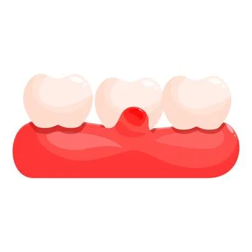 Gum swelling between teeth showing gingivitis or periodontitis Illustrazione stock