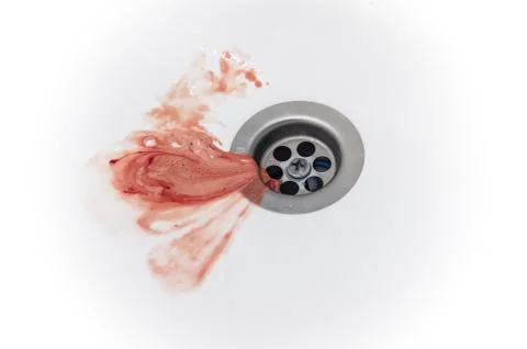 Gums bleed when brush the teeth and blood in toothpaste foam on white sink Stock Photos
