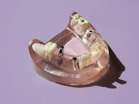 Gums model with caries, implants and teeth on pink background Stock Photos