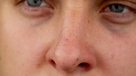 Guy with acne on her nose. macro video of the problematic skin of the nose and a Stock Footage 92860314