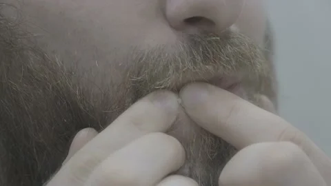 The guy pops a pimple. A man squeezes a pimple close-up. Pimple on face Stock Footage 194582465