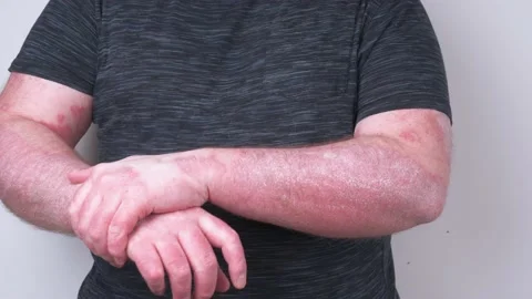 The guy scratches his hands covered with psoriasis, which itch very much and  Stock Footage 152629488