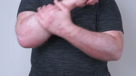 A guy smears his hands with ointment, his hands covered with psoriasis, which Stock Footage 152629702