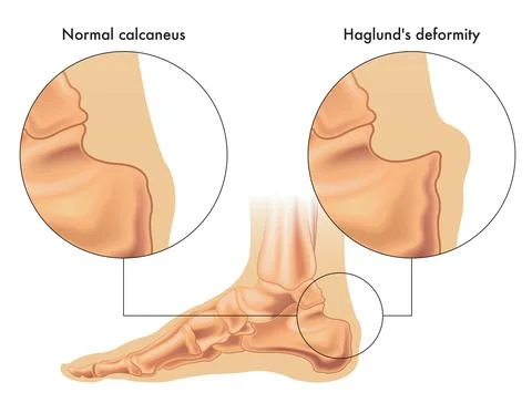 Haglund's deformity Stock Illustration