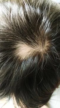 Hair fall Stock Photos
