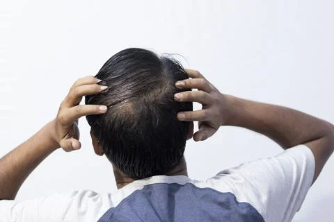 Hair fall problem for men Stock Photos