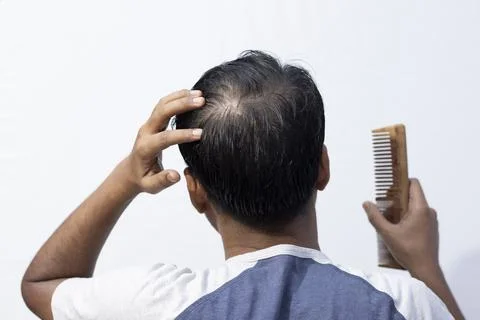 Hair fall problem for men Stock Photos