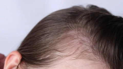 Hair loss and baldness problem in women close-up Stock Footage 346246771