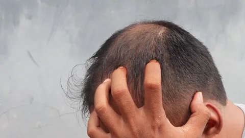 Hair loss Видео 332882422
