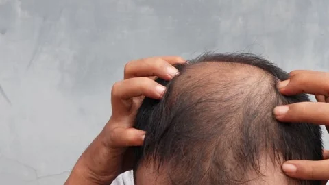 Hair loss Stock-Footage 332882423
