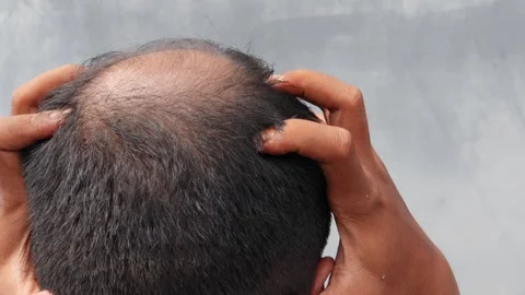 Hair loss Stock-Footage 332882432