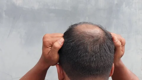 Hair loss Stock-Footage 332882433