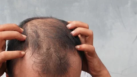 Hair loss Stock-Footage 332882437