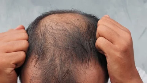 Hair loss Stock-Footage 332882461