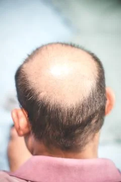 Hair loss problem, Close up of head man less hair. Baldness in men puts a dam Stock Photos