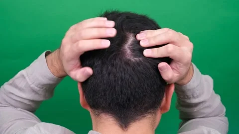 Hair loss problem Stock Footage 288763232