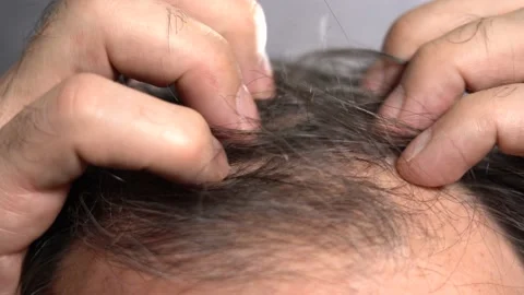 Hair Loss Problem in Old Age Men Stock Footage 161335125
