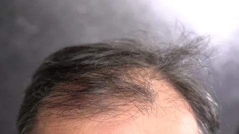Hair Loss Problem in Old Age Men Видео 166105528