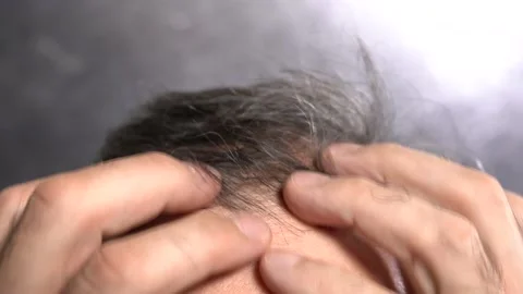 Hair Loss Problem in Old Age Men 스톡 동영상 166105715